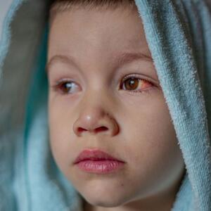 Kako izgleda KONJUKTIVITIS? Postoje 3 vrste upale, a simptomi mogu da se razlikuju u zavisnosti od toga šta je izaziva
